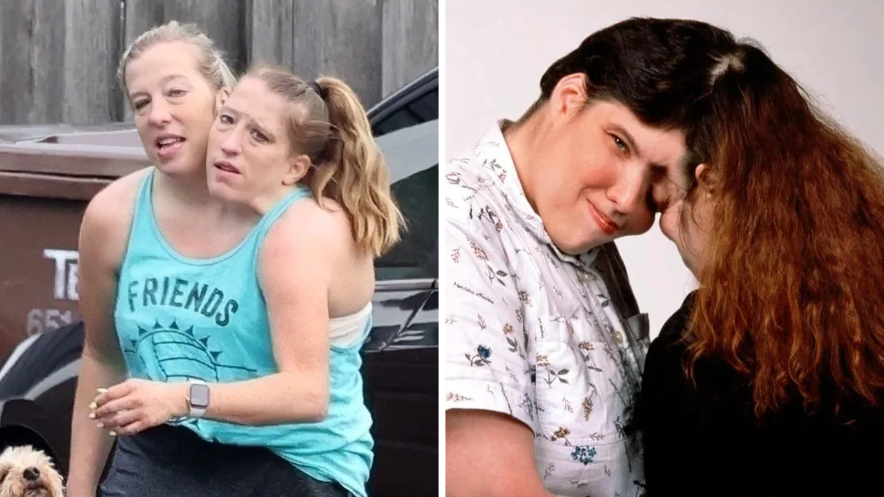 20 Famous Conjoined Twins With Incredible Life Stories