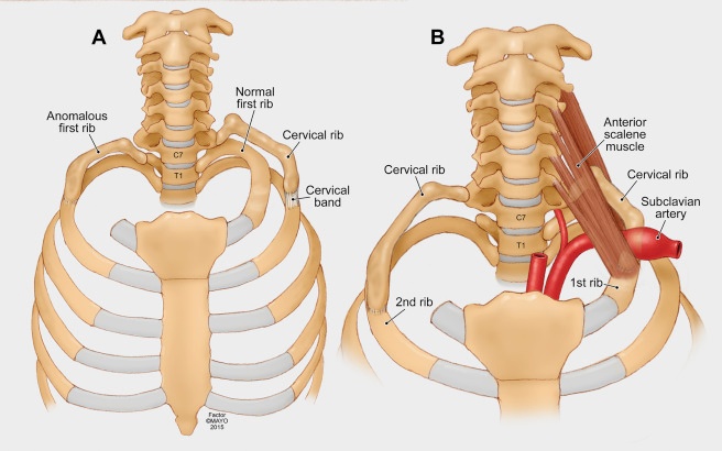 Extra Rib On Person Visual Example 25 Human Features That Are Actually Extremely Rare - Kate Knows